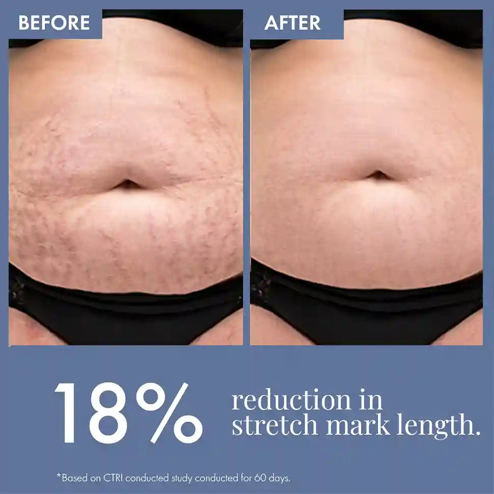 Thriveco Stretch Marks Expert Serum Cream