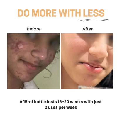 Chosen Light Routine Easy Salicylic Acid Peel bottle with dropper, showcasing the premium skincare product. - Image 3